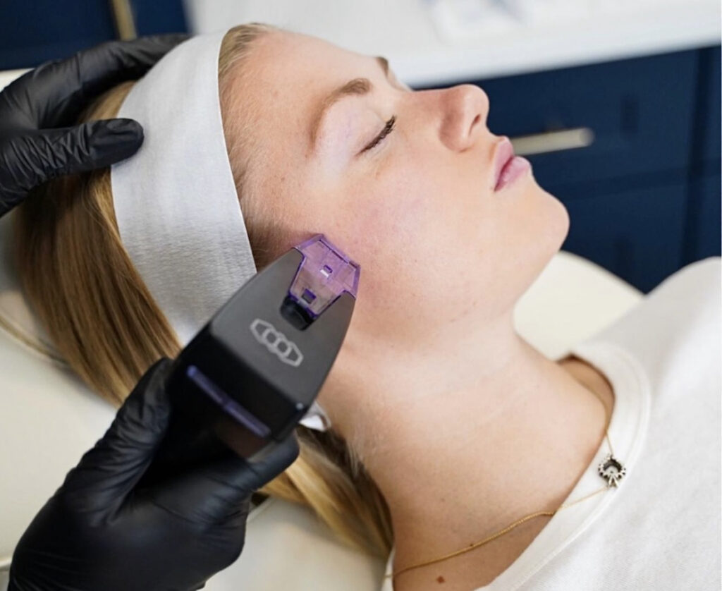 radio frequency microneedling in barrie