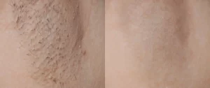 Does Laser Hair Removal Remove Hair Permanently