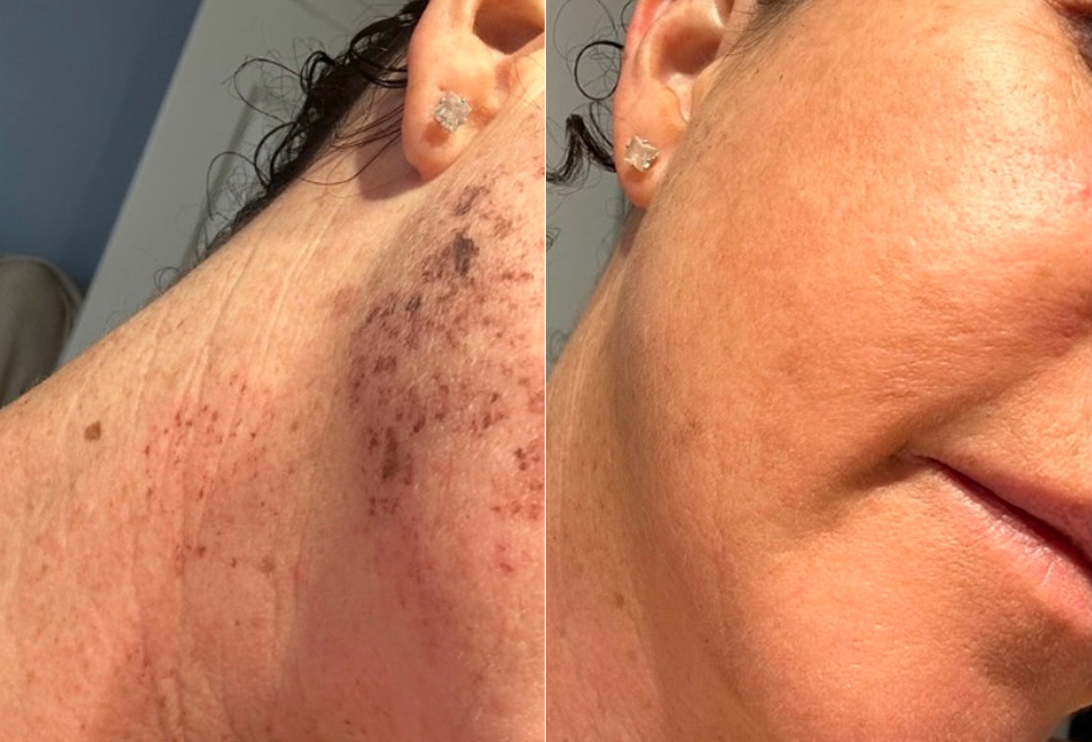 IPL laser treatment on woman's face