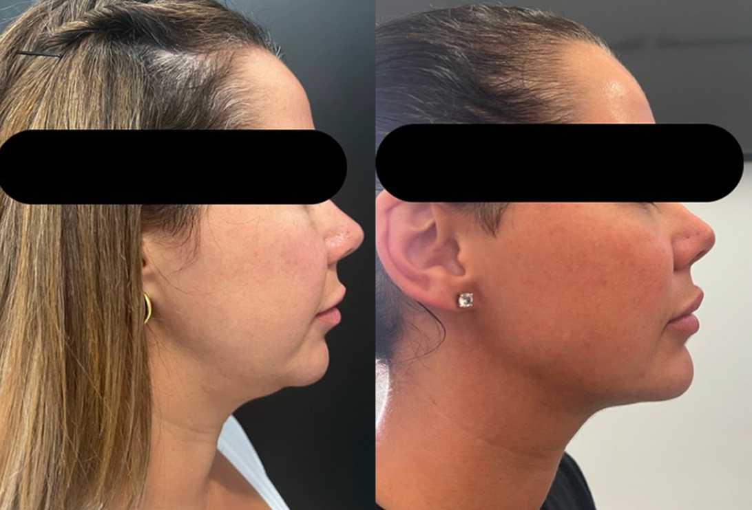 face contouring on female client