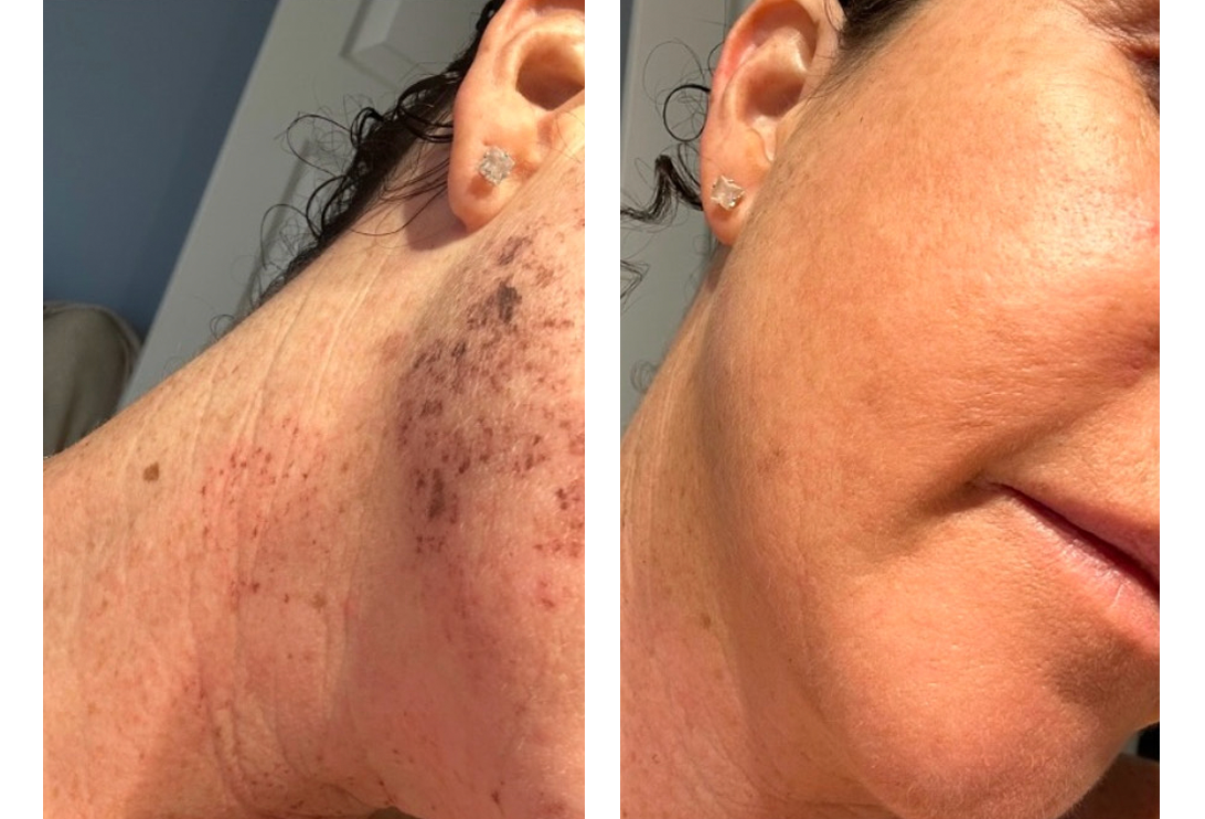 lumecca IPL face after 1 treatment