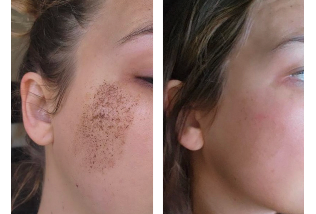 lumecca IPL treatment before and after