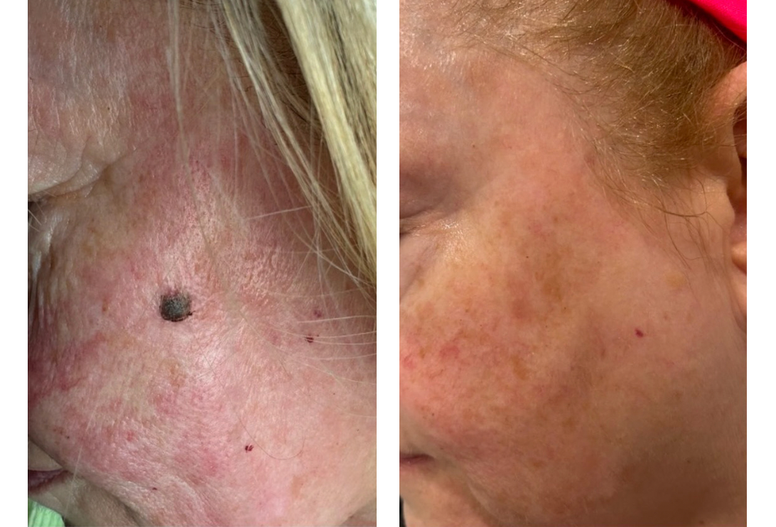 lumecca IPL treatment before and after