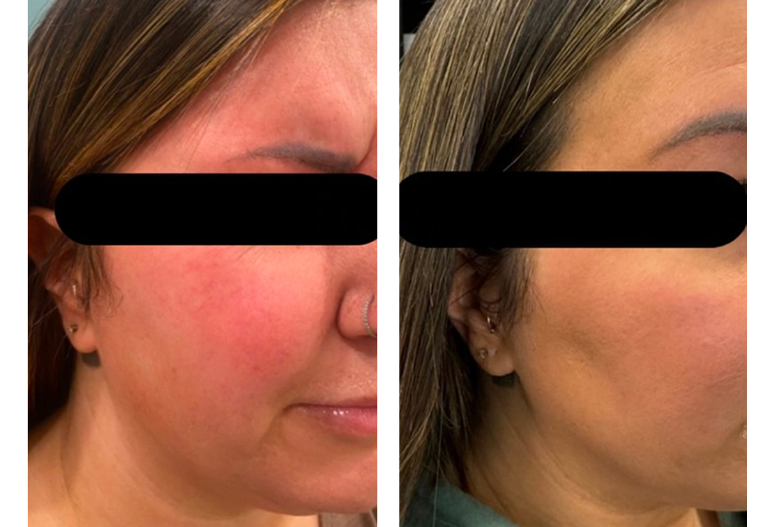 face treatment before and after