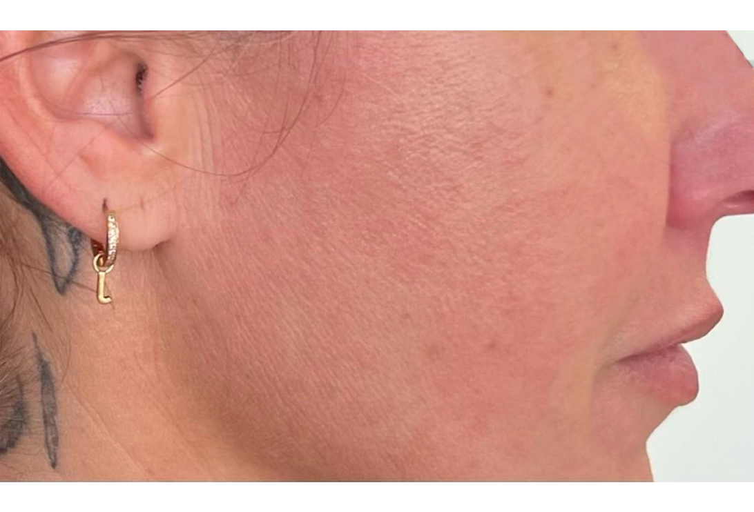 face treatment result after