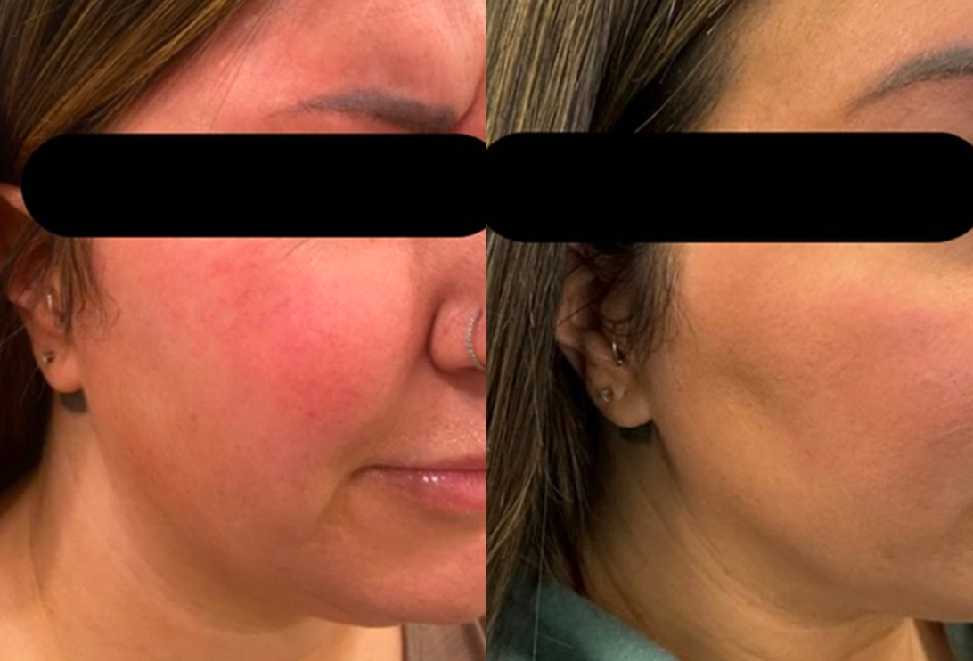 laser face sculpting and laser treatment on woman