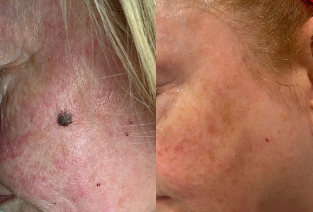 IPL Lumecca laser treatment on woman face