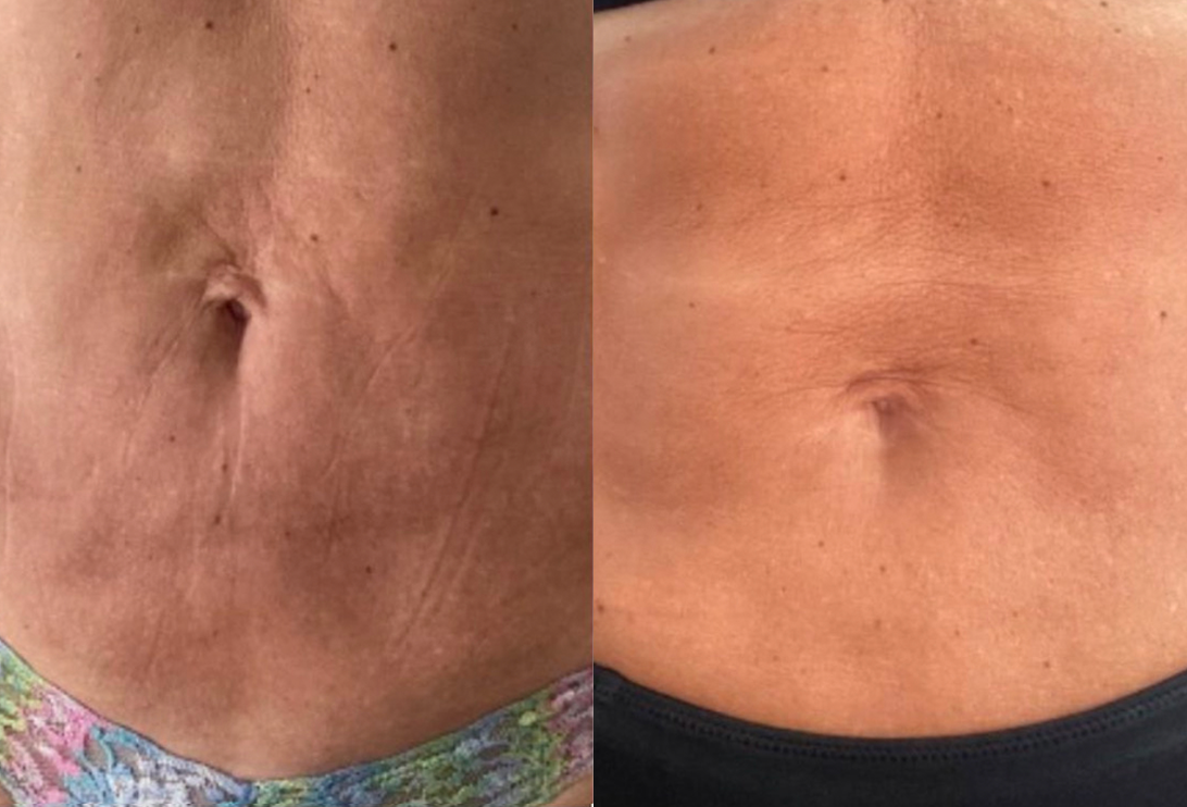 body sculpting results on female client stomach