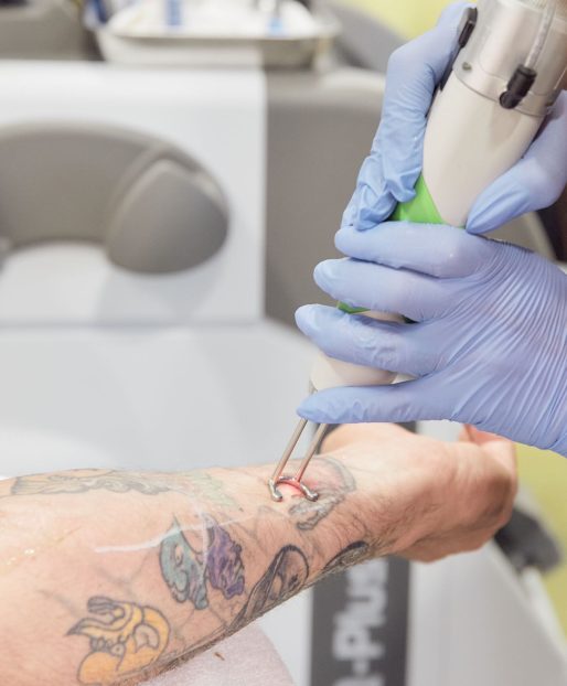 tattoo removal